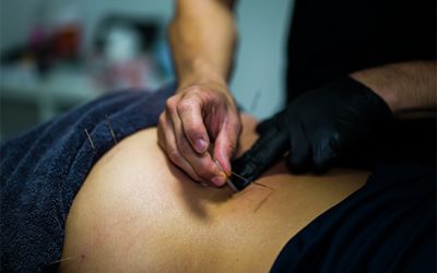 Dry Needling Near Me: The Art of Healing