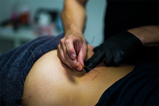 Dry Needling Sydney