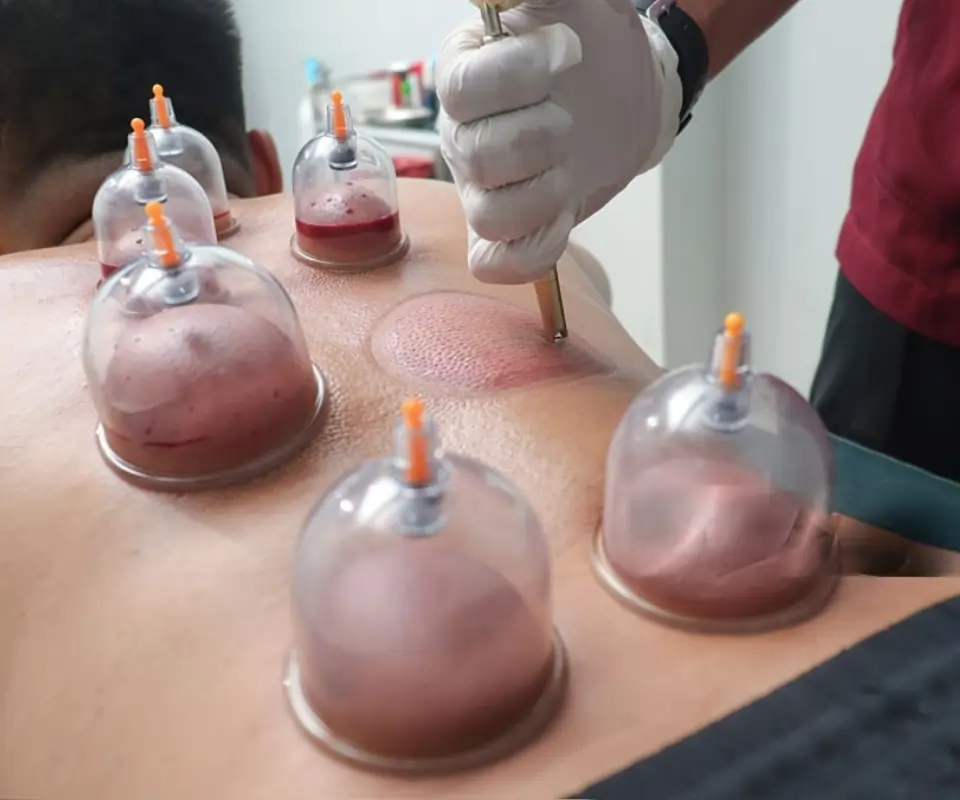 Hijama Wet Cupping